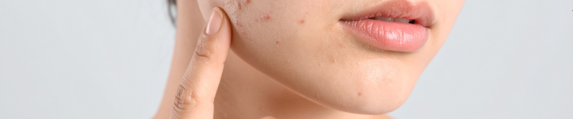 Acne Prone Skin